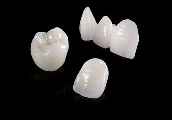 Vollkeramik – Zahnarztpraxis Alt & Brandl Vollkeramik – Zahnarztpraxis Alt & Brandl